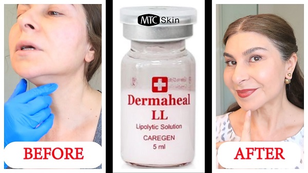 Hướng dẫn cách dùng Dermaheal LL
