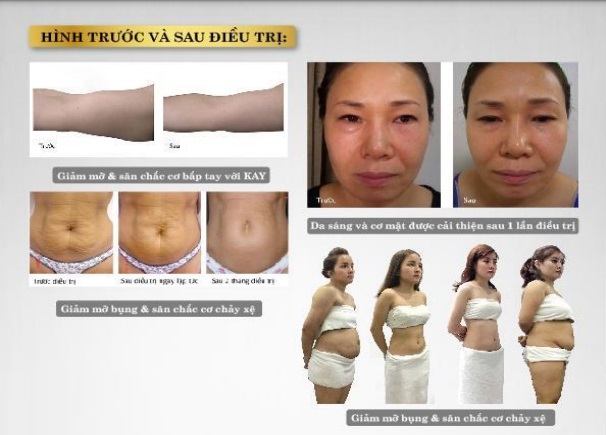 Giảm béo công nghệ cao ưu và nhược điểm