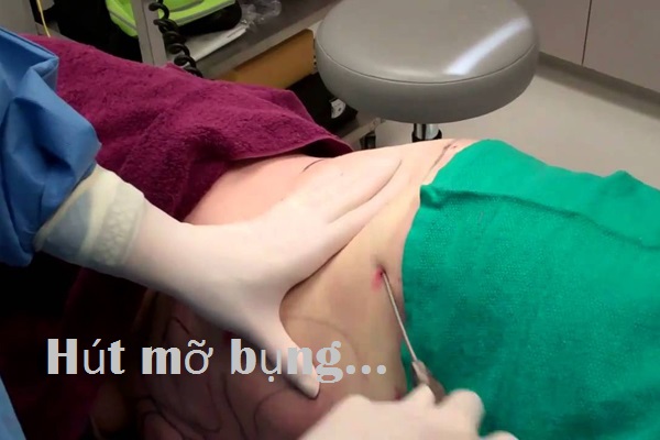 Hút mỡ bụng là gì