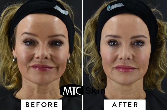 Hiệu quả sau liệu trình nâng cơ RF