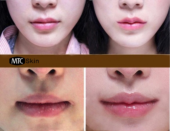 sau khi tiêm filler bao lâu thì mềm