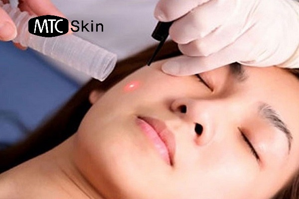 cách chăm sóc sau khi tiêm filler