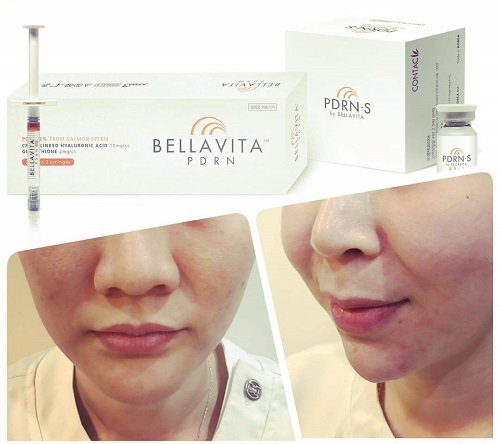 Các sản phẩm tiêm Bellavita PDRN dùng cho spa