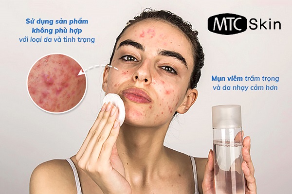 Cách chọn sản phẩm skincare cho da mụn
