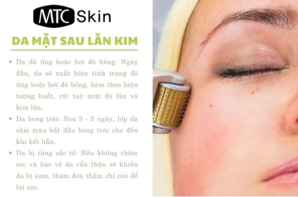 Lăn kim có thể gặp phải những tác dụng phụ gì?