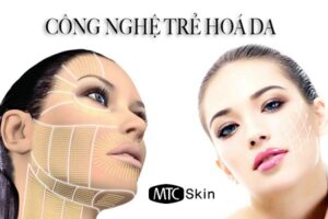 4 Công nghệ nâng cơ mặt mới nhất, hiệu quả nhất hiện nay