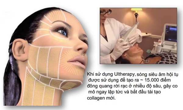 Công nghệ nâng cơ mặt bằng Ultherapy