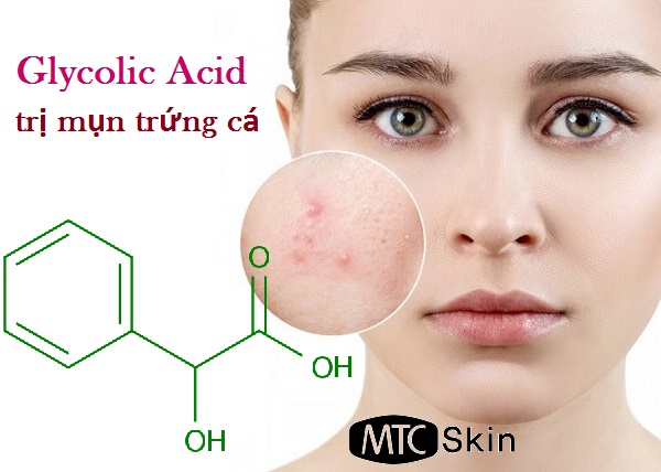 Glycolic Acid trị mụn trứng cá