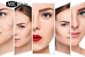 Nâng cơ mặt là gì? Nâng cơ trẻ hóa da mặt có hại không?