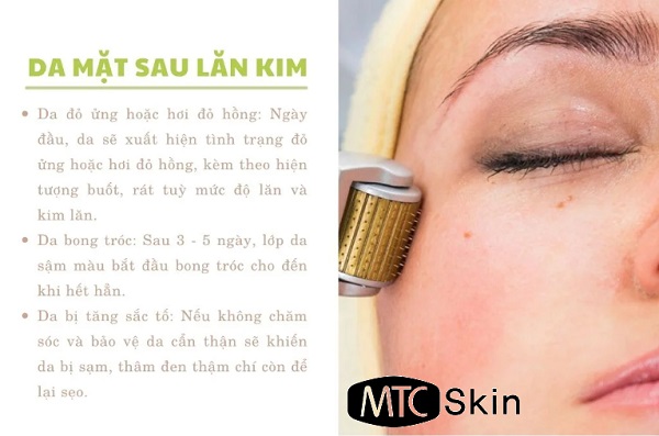 Một số lưu ý về chăm sóc da sau khi lăn kim