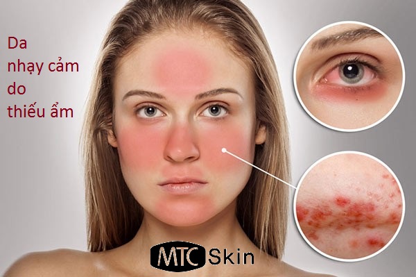 Dấu hiệu da thiếu ẩm