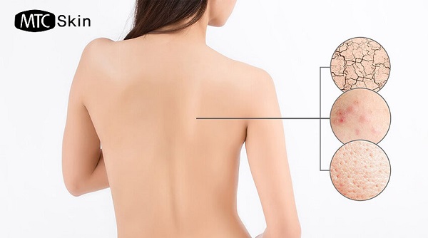 Xác định loại da của bạn trước khi tẩy tế bào chết