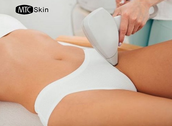 Triệt lông vùng kín bằng laser