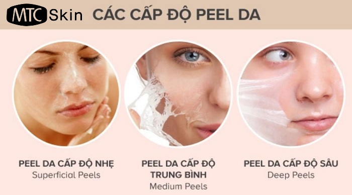 Các cấp độ peel da