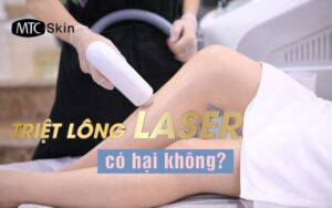 Triệt lông bằng laser có hại không?