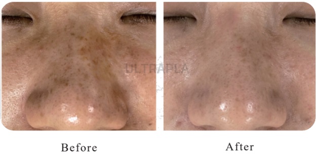 hiệu quả điều trị