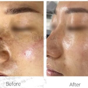 điều trị da với ULTRAPLA