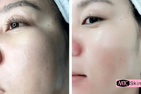 Cấy tinh chất vào da