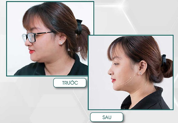 Tiêm tan mỡ bao lâu có tác dụng?