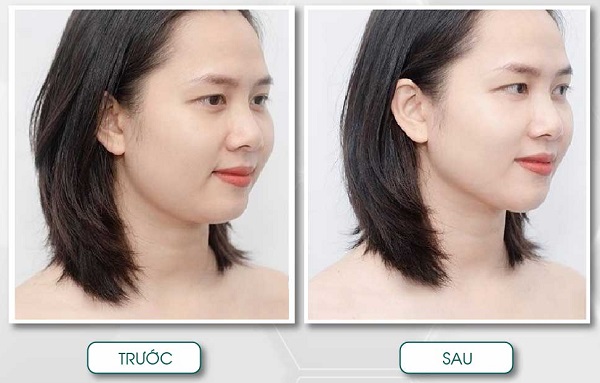 Tiêm tan mỡ bao lâu có tác dụng?