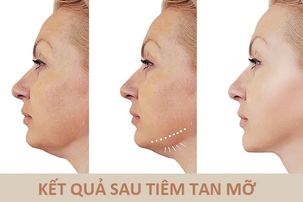 Tiêm tan mỡ có hiệu quả không?