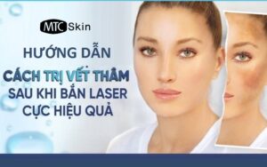 Cách trị vết thâm sau khi bắn laser