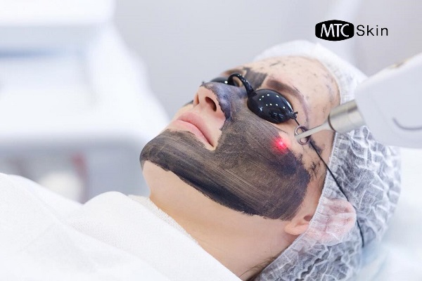 Cách chăm sóc da trước khi bắn laser carbon