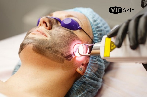 laser carbon than hoạt tính