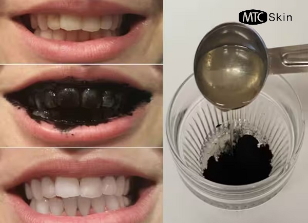 Than hoạt tính làm trắng răng