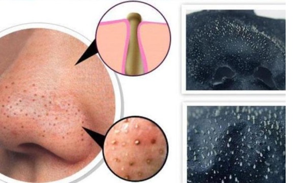 Tác dụng của than hoạt tính trong làm đẹp